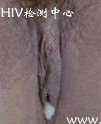 女性淋病图